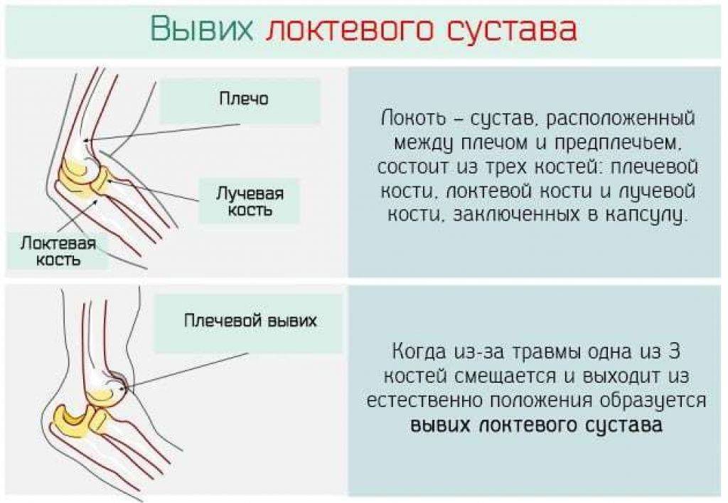 На рисунке изображена травма которая называется вывих сустава