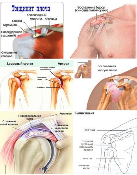 Боли в плечах: причины и лечение боли в плечевом суставе