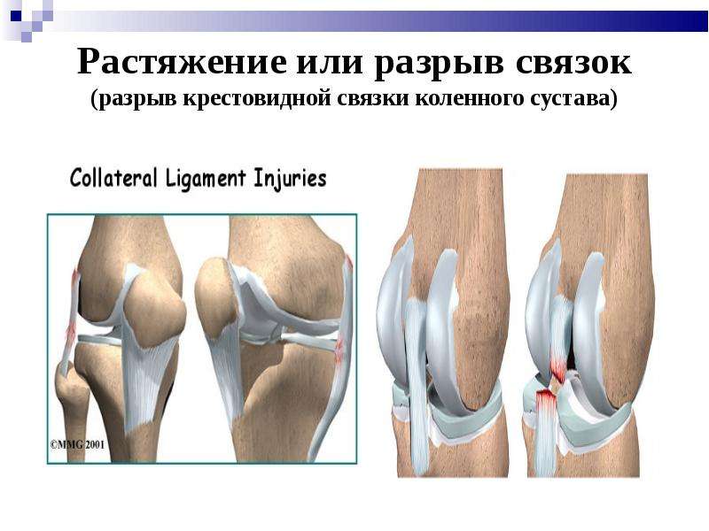 Лечение при растяжениях и разрывах связок колена - диагностика, первая помощь, восстановление связок