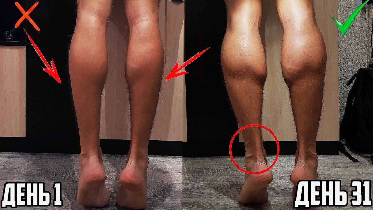 Как уменьшить толстые икры ног. липосакция голени