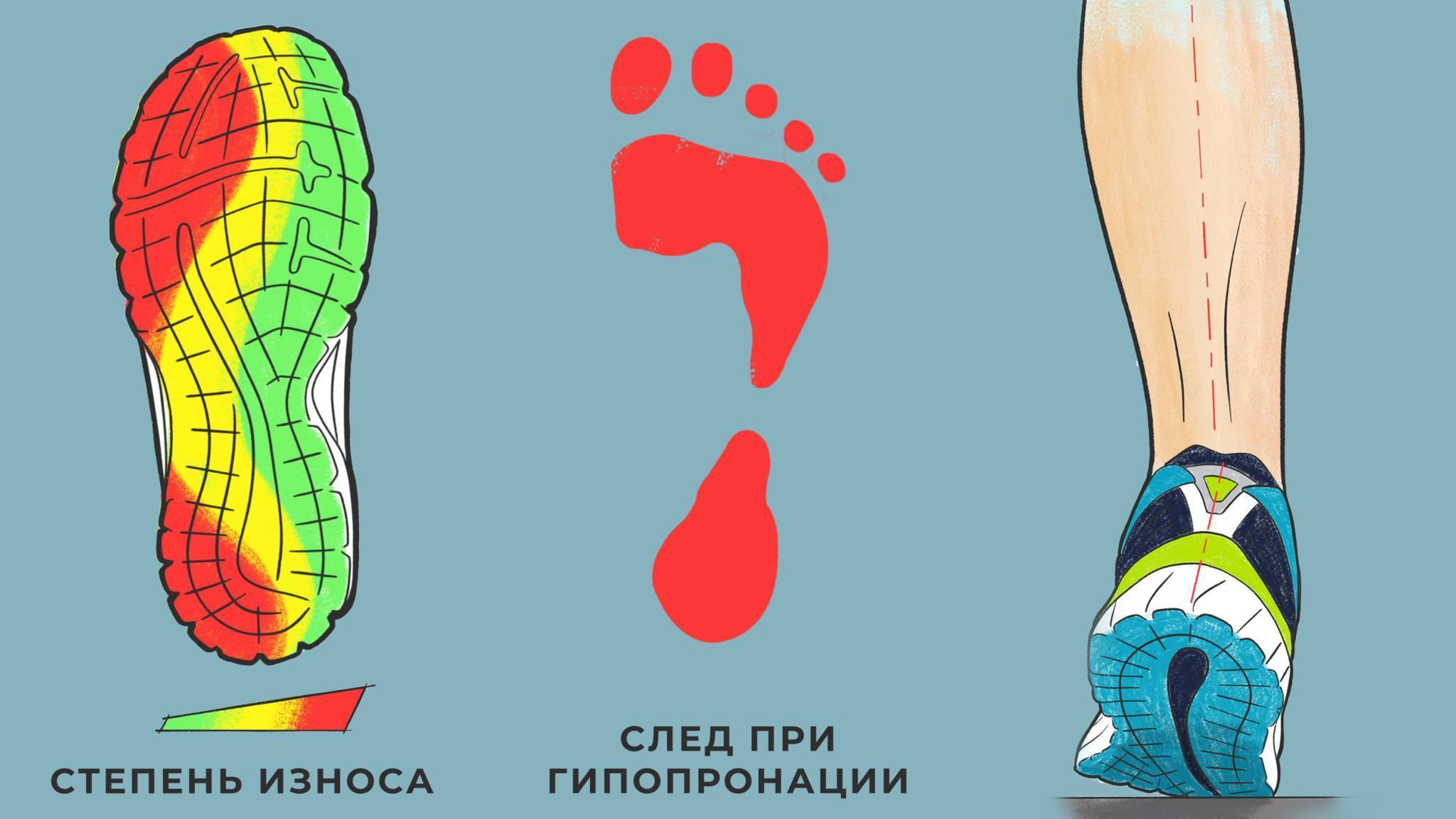 Бег при плоскостопии — правила выбора лучших кроссовок