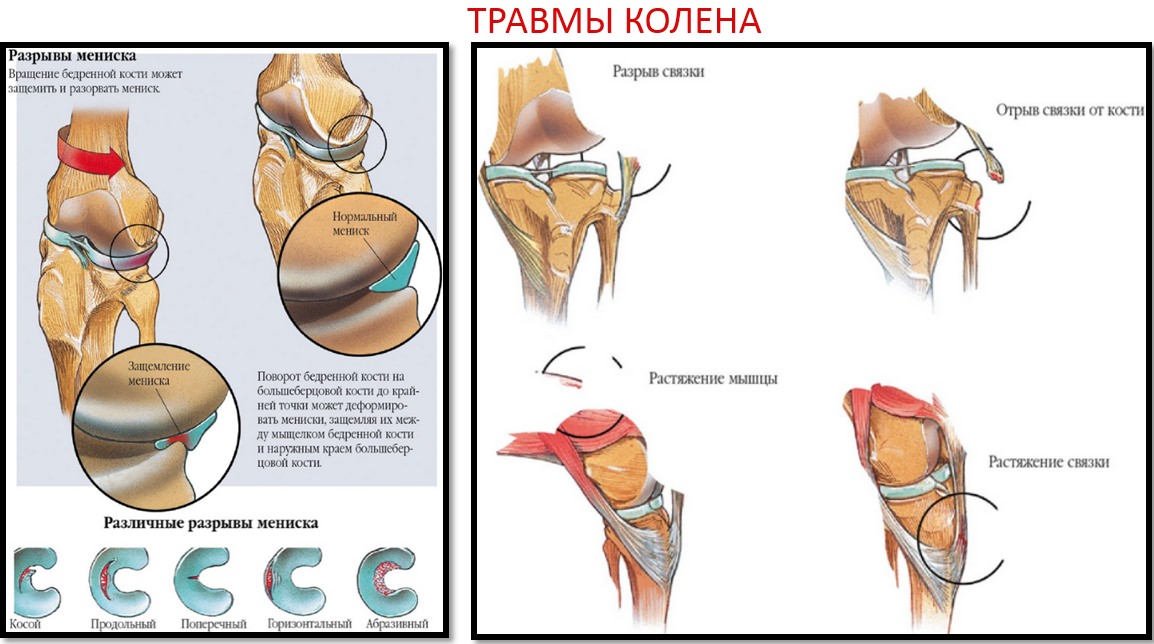 Сколько болит колено после растяжения