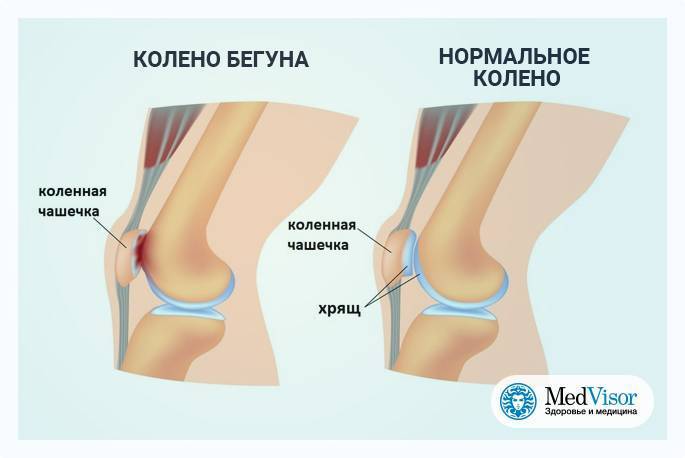 Почему возникает боль под коленом спереди – симптомы заболеваний, стадии развития и корректное лечение