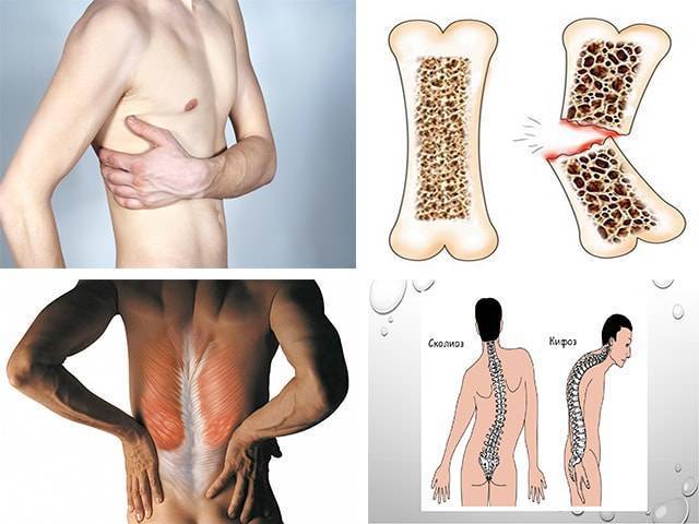 Защемление нерва в грудном отделе позвоночника: симптомы, лечение