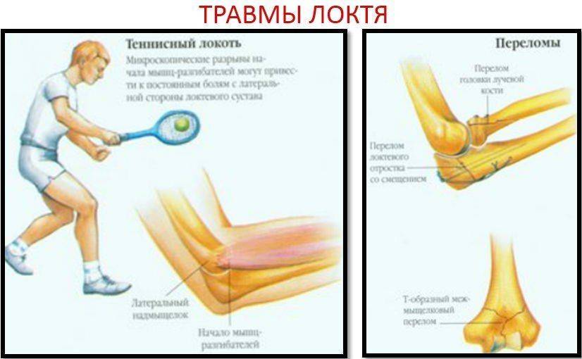 Перелом локтевого сустава: виды, симптомы, диагностика