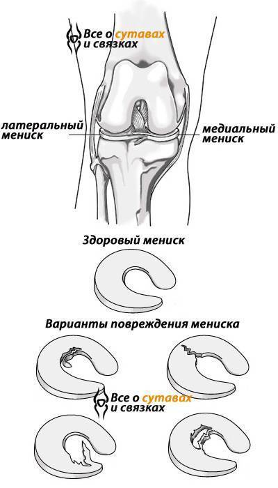 Воспаление мениска коленного сустава