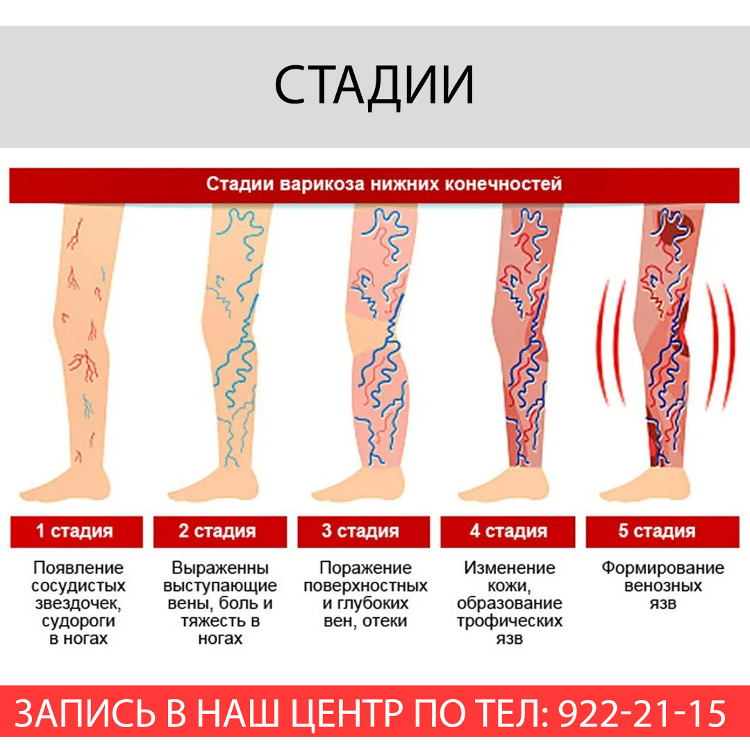 Варикозное расширение вен нижних конечностей карта вызова скорой медицинской помощи