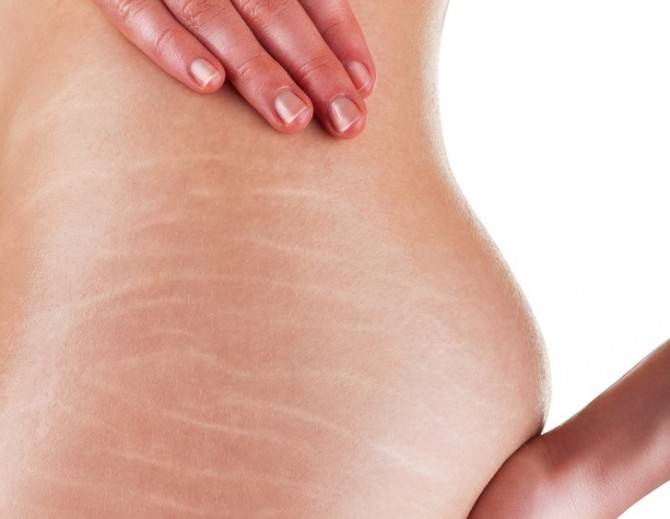 Как избавиться от лишней кожи на животе после похудения и родов?