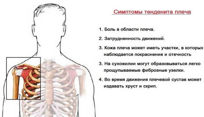 Боль в плечевом суставе: причины, проблем и как лечить