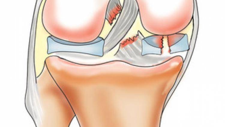 Мениск коленной чашечки. Мениск коленной чашечки разрыв. Менисцит коленного сустава.