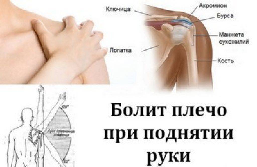 Лечение артроза плечевого сустава - нолтрекс.