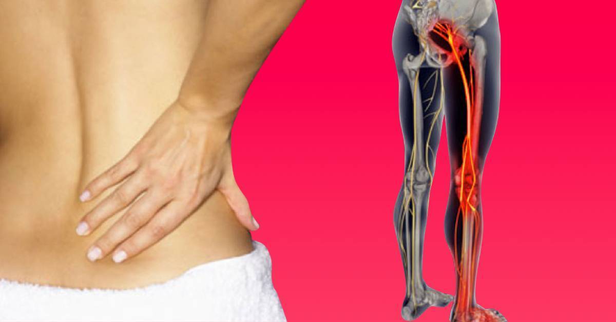 Защемление седалищного нерва (ишиалгия) - vertebra