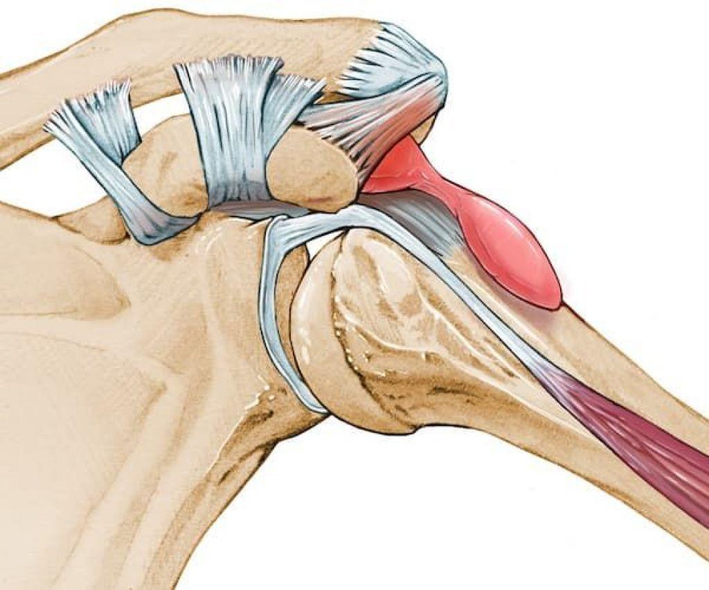 Импиджмент левого плечевого сустава. Субакромиальный бурсит. Импиджмент синдром плеча. Импинджмент синдром плечевого сустава. Сухожилия плечевого сустава анатомия.