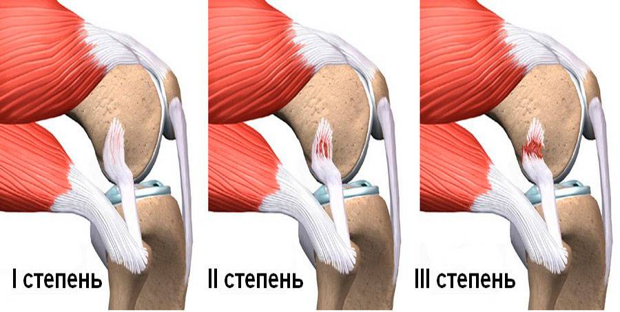 Разрыв латеральной связки коленного сустава, разрыв боковой, наружной и внутренней связок сустава, лечение в германии