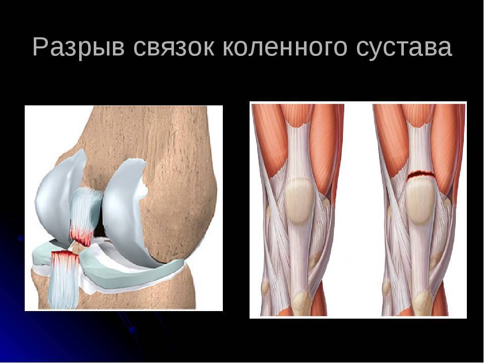 Растяжение связок коленного сустава [лечение методом увт]