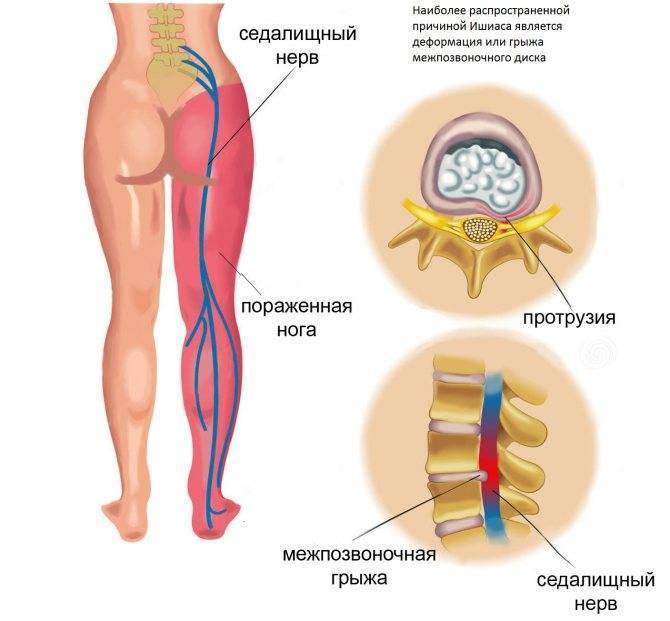Защемление седалищного нерва (ишиалгия) - vertebra