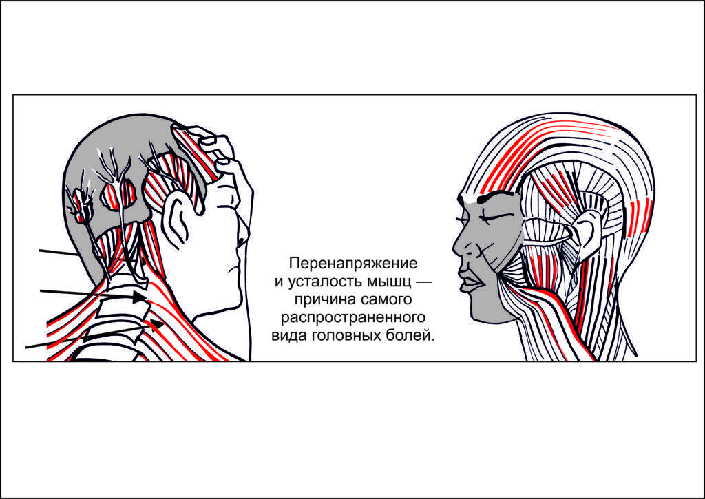 Гипертонус мышц спины у взрослых: лечение, причины, диагностика