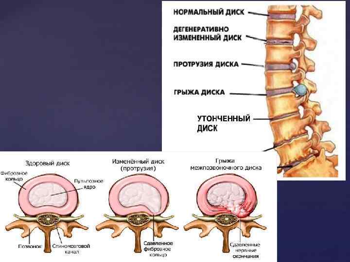 Виды протрузий и их лечение - vertebra