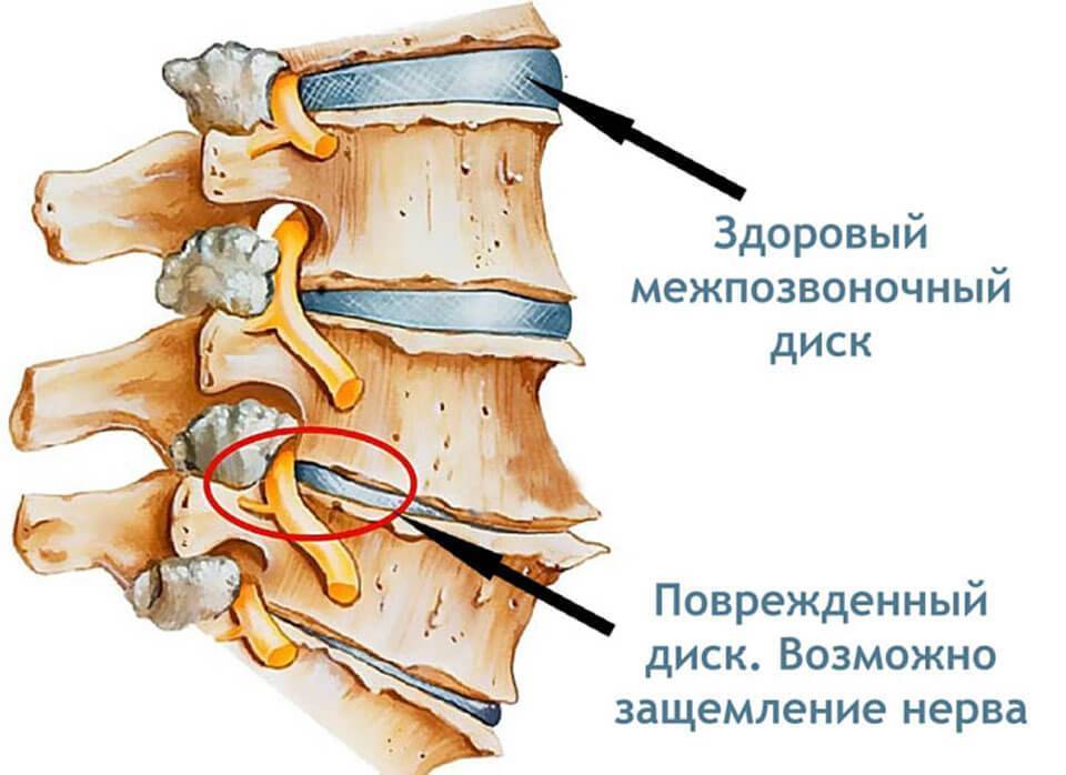 Шейный остеохондроз ️: симптомы, признаки и лечение остеохондроза шейного отдела