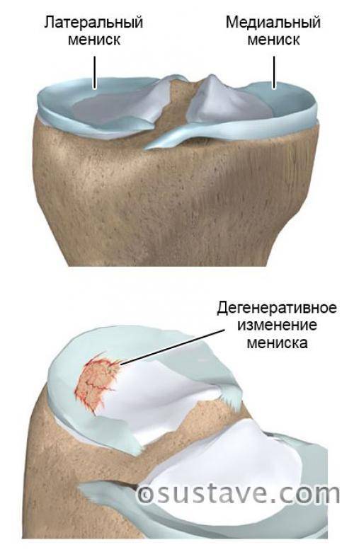 Лечение разрыва мениска коленного сустава без операции