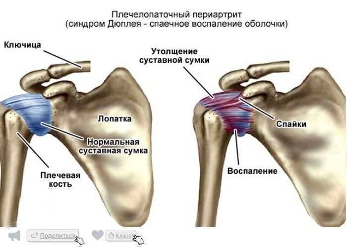 Боль в плечевом суставе ️: причины возникновения, диагностика и лечение