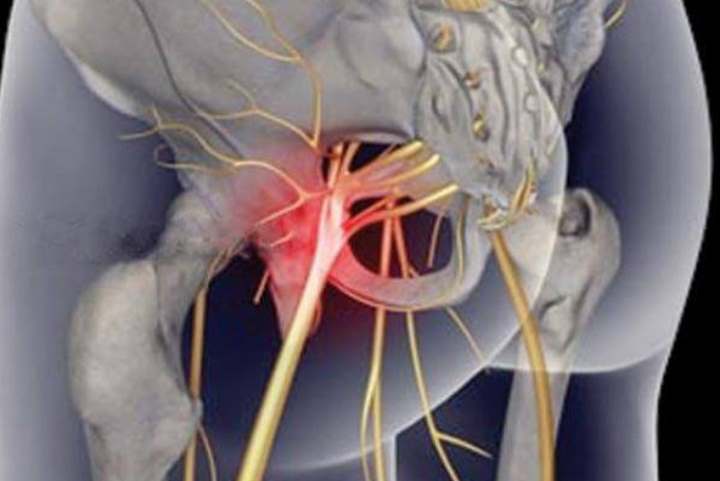 Защемление седалищного нерва: причины, симптомы, последствия и способы лечения
