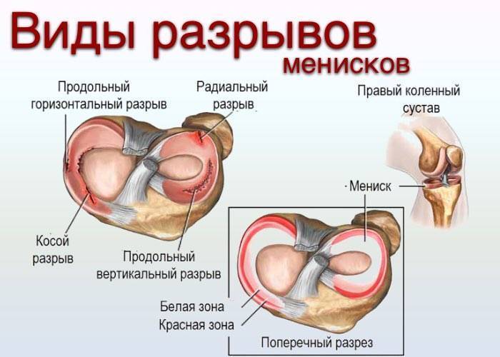 Мениск колена лечение