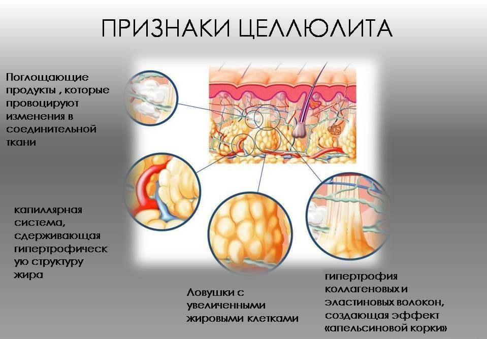 Это бронхит на целлюлит на