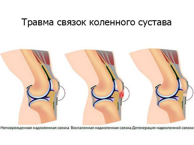 Разрыв связок коленного сустава