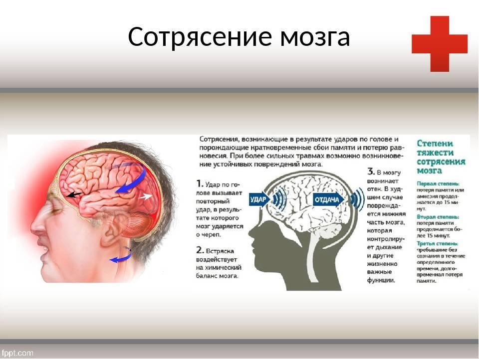 Сотрясение головного мозга - симптомы, признаки, степени, первая помощь и лечение