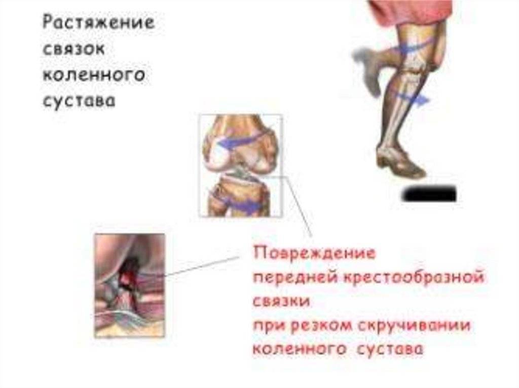 Восстановление связок коленного сустава