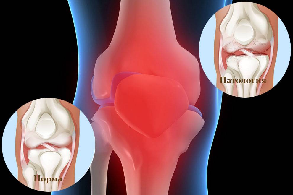 Мениск коленного сустава - травматизм, лечение, профилактика